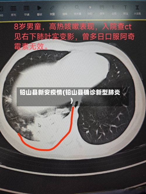 铅山县新安疫情(铅山县确诊新型肺炎)